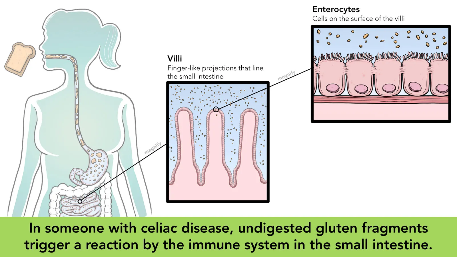 Gut Reaction - Celiac Disease hero