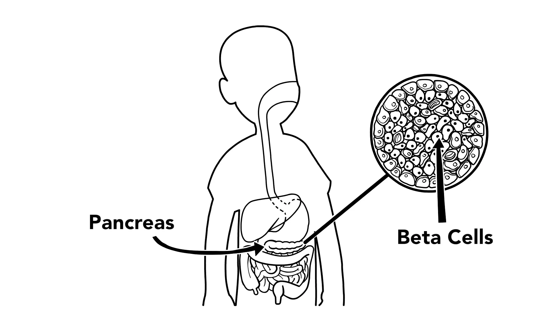 Diabetes Whiteboard Videos hero